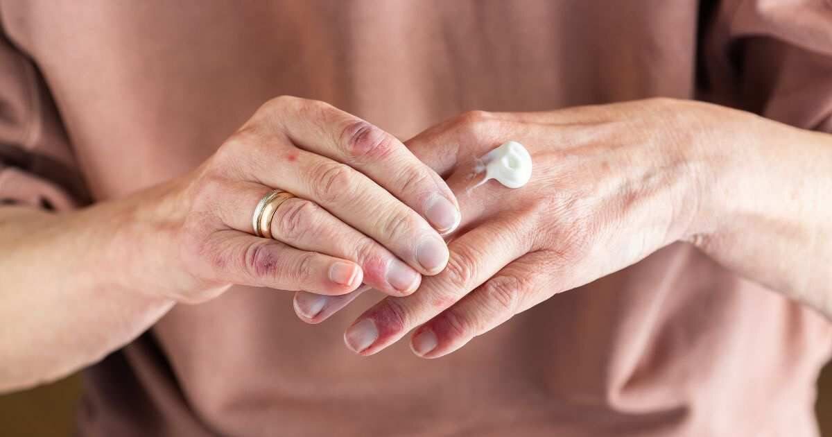 Hands applying cream for dry skin